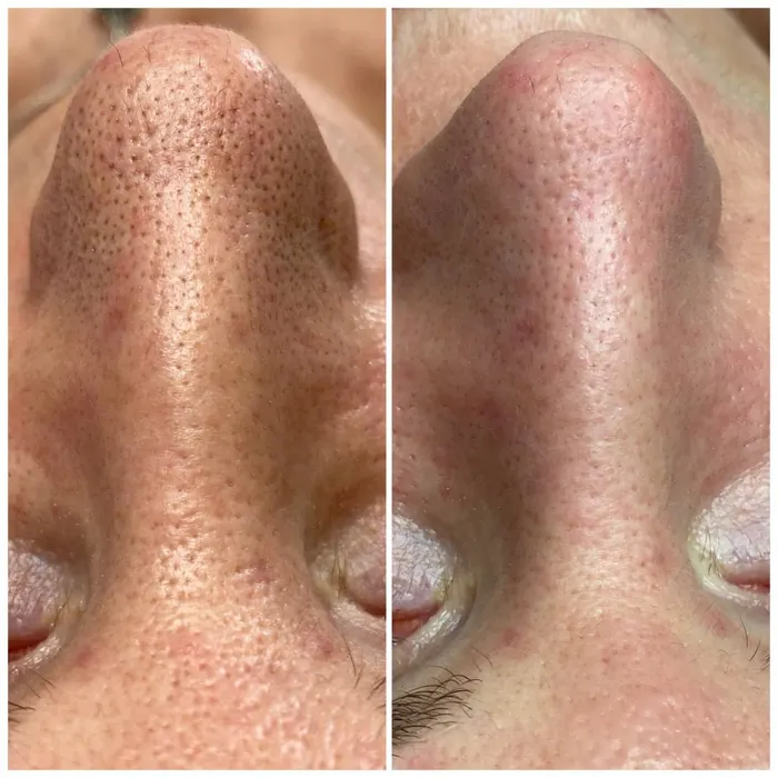 Before and after: pores after deep cleansing facial