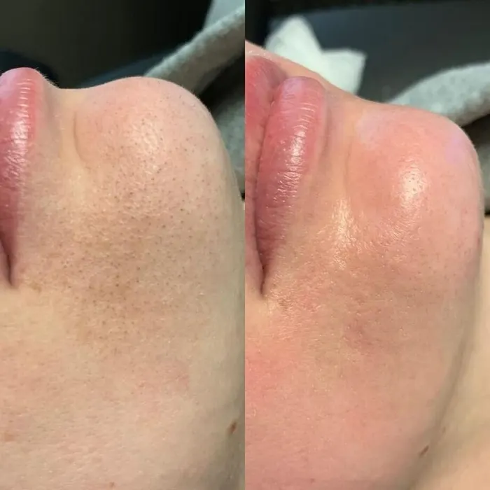 Before and after: redness reduction