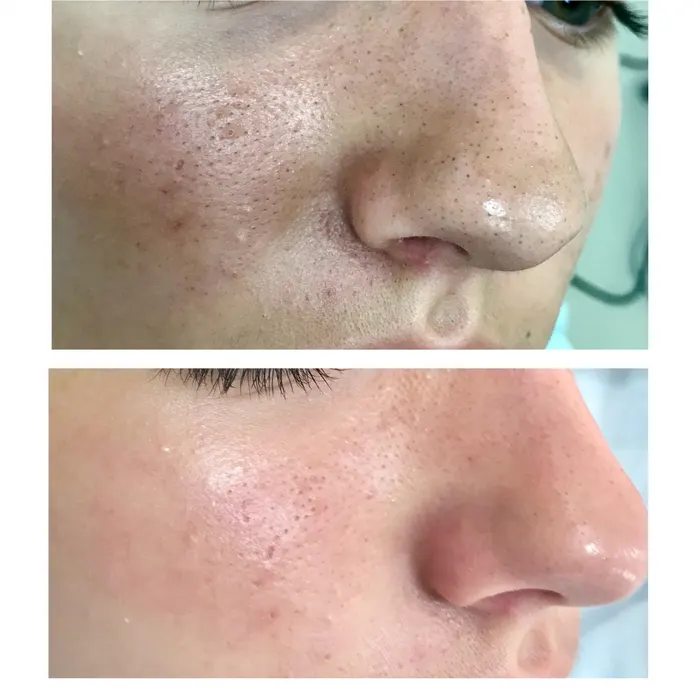 Before and after: smoother skin texture