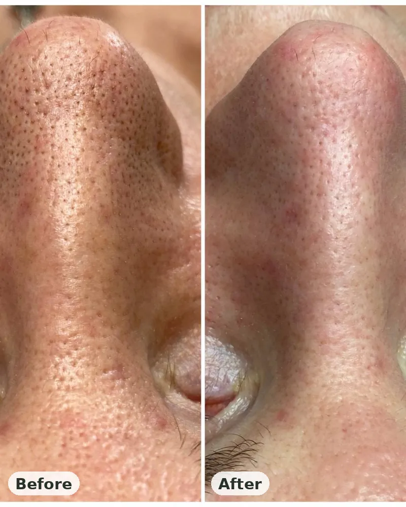 Before and after: clearer, refined pores after a deep cleansing facial