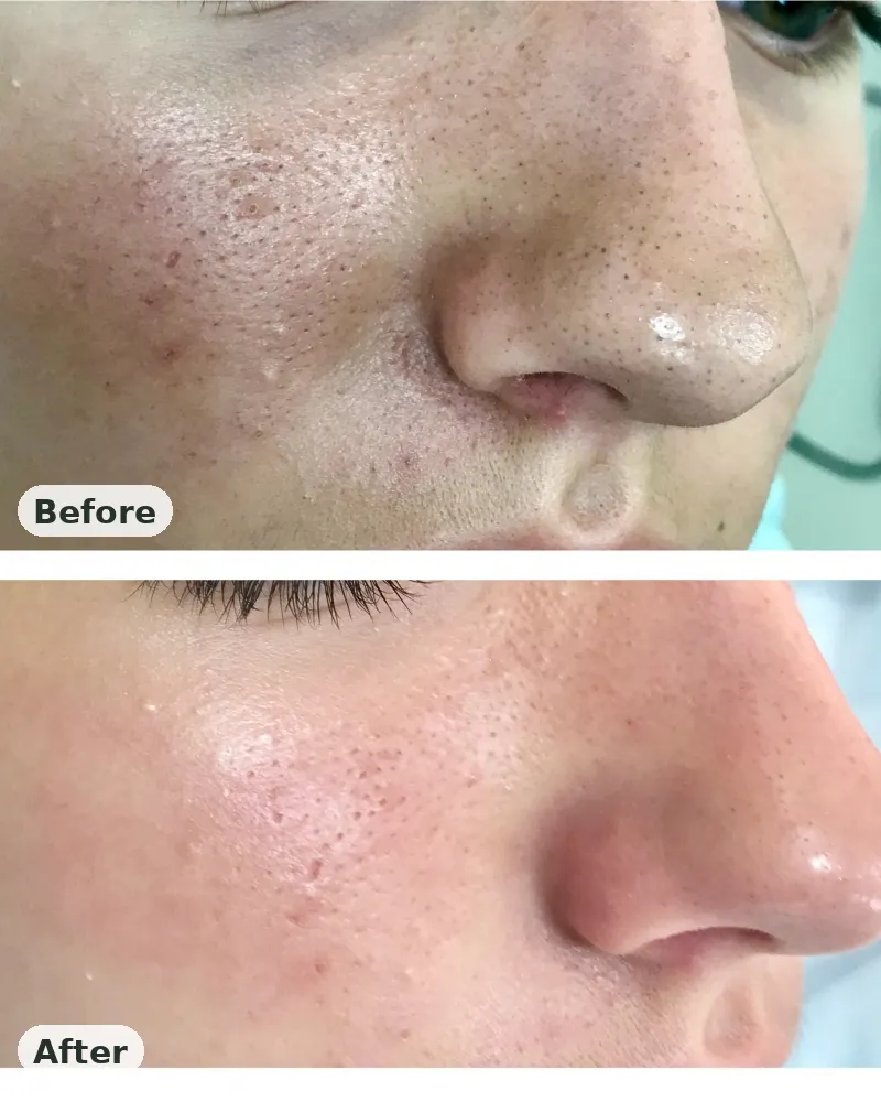 Before and after: calmer, smoother skin texture